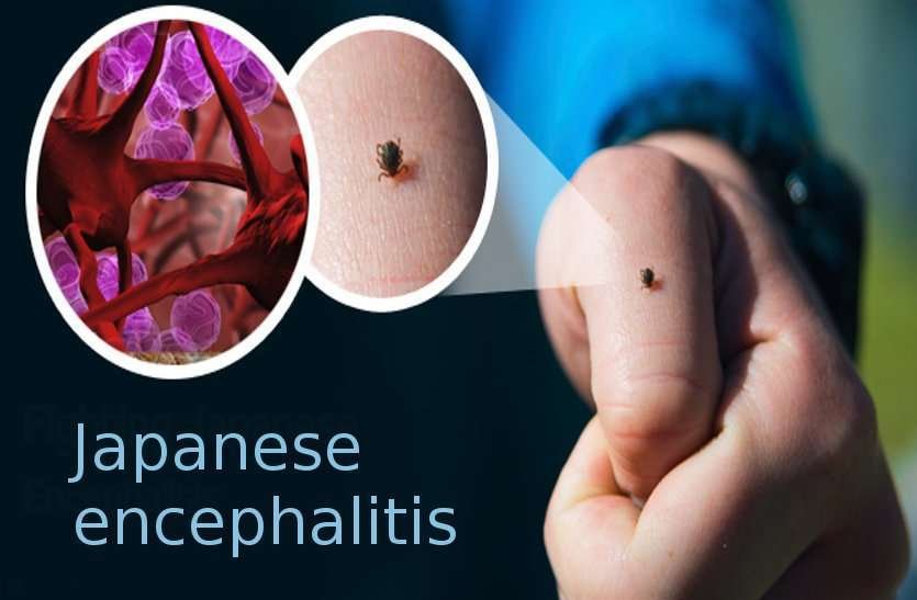 जमशेदपुर में जापानी बुखार के मरीज की पुष्टि, TMH में चल रहा इलाज